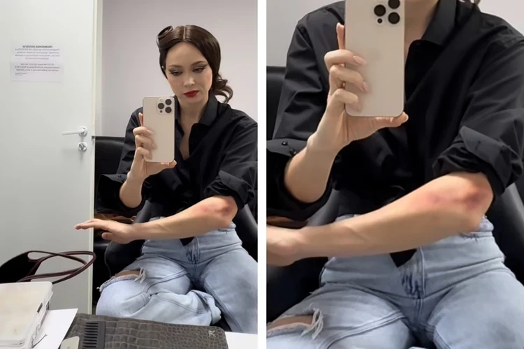 Настасья Самбурская показала гематому: «Меня сбил мопедист на пешеходном переходе»